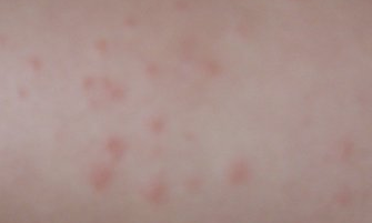 Как проявляется аллергия у человека: основные симптомы и ощущения