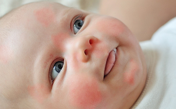 Препараты от аллергии для новорожденных – какой выбрать?